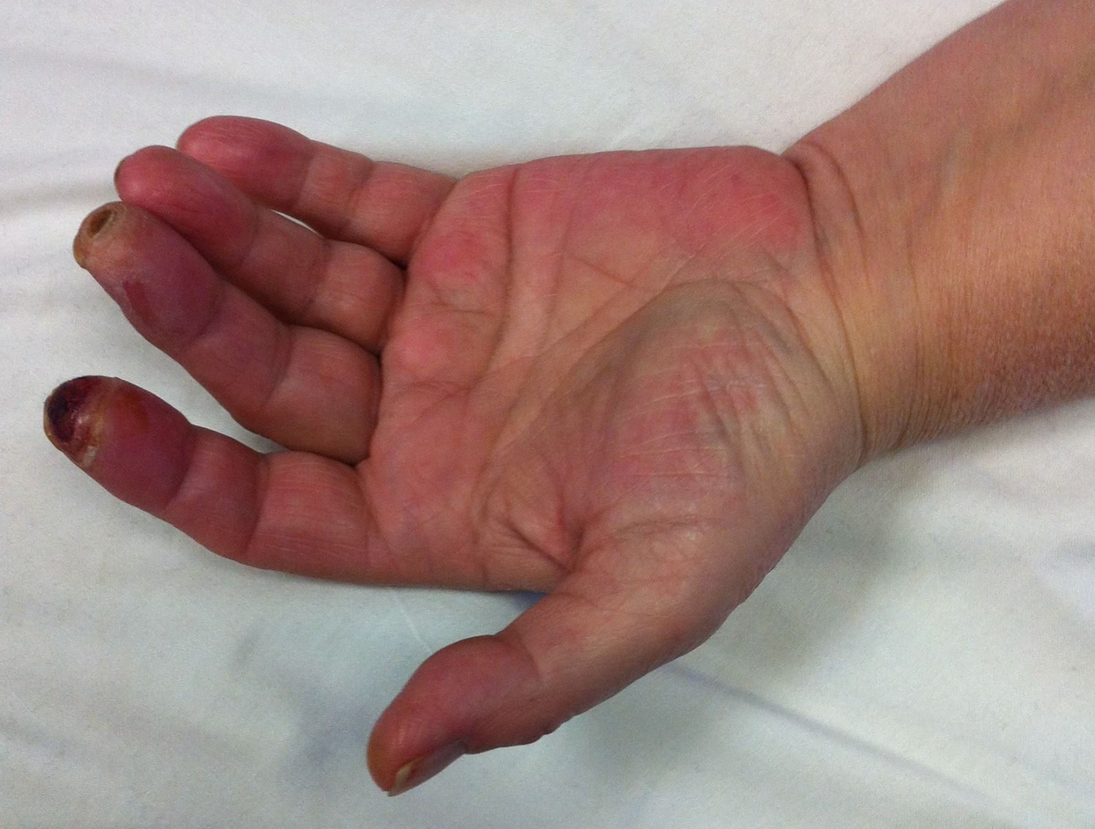 Of the many causes of swollen fingers, most are not serious